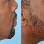 La greffe de barbe catastrophique du footballeur Younousse Sankharé