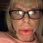 Son opération pour avoir les lèvres pulpeuse de Kylie Jenner tourne au drame